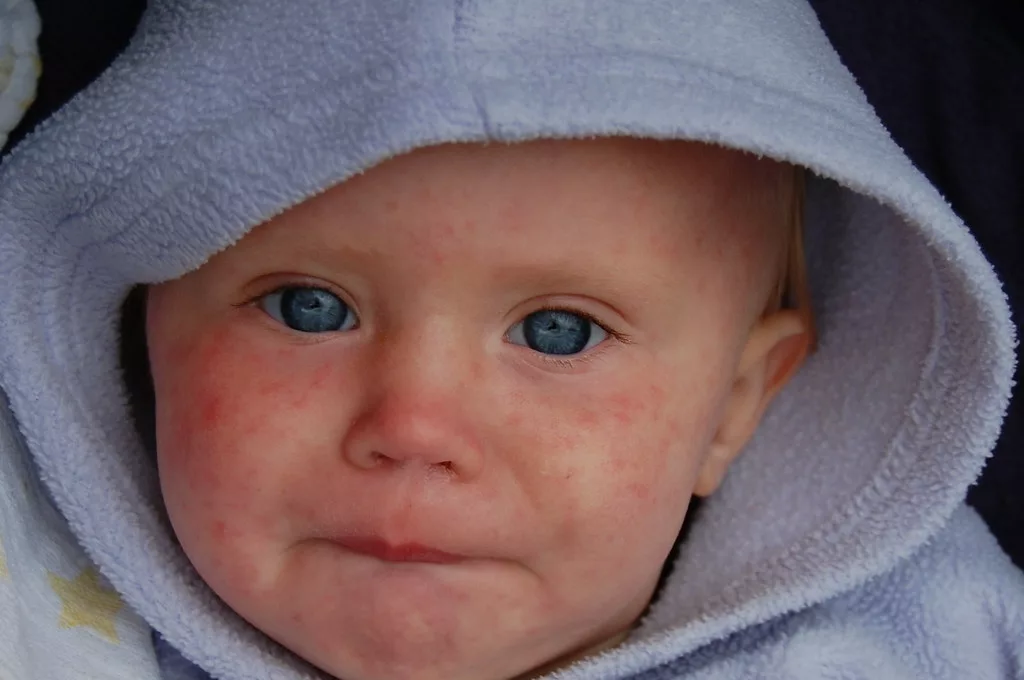 Measles: Symptoms and Treatment in Children